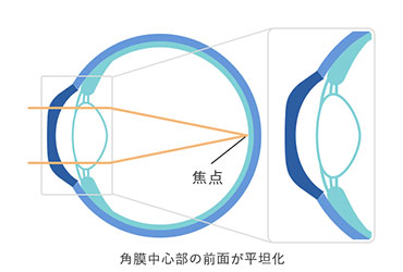 オルソケラトロジーレンズ装用後